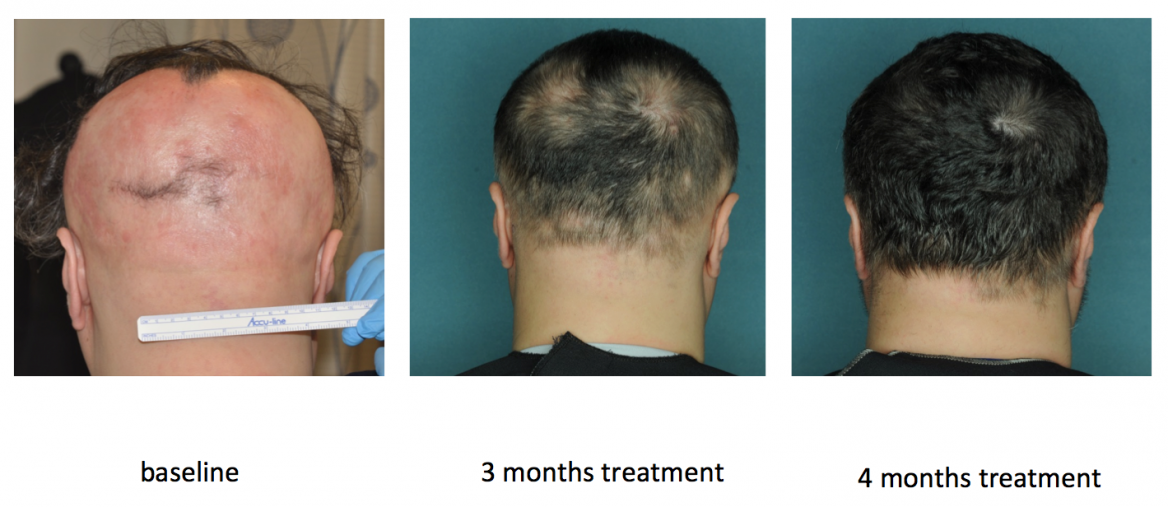 Hair regrowth after ruxolitinib treatment of a patient with alopecia areata. Credit: Lab of Dr. Angela Christiano/Columbia University Medical Center